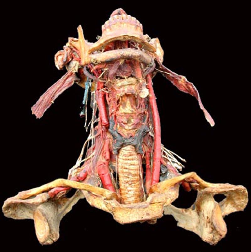 Dissection de la carotide