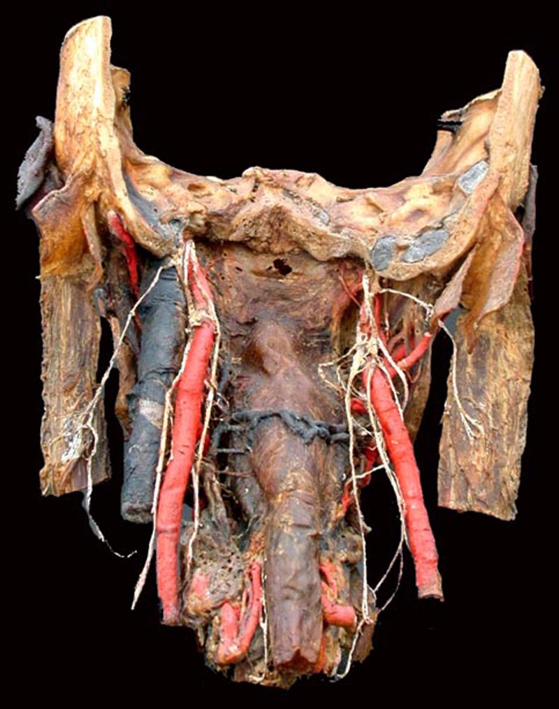 Dissection de la carotide