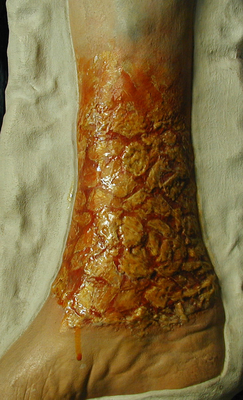 Cire anatomique d'une pathologie en dermatologie (Fontana)