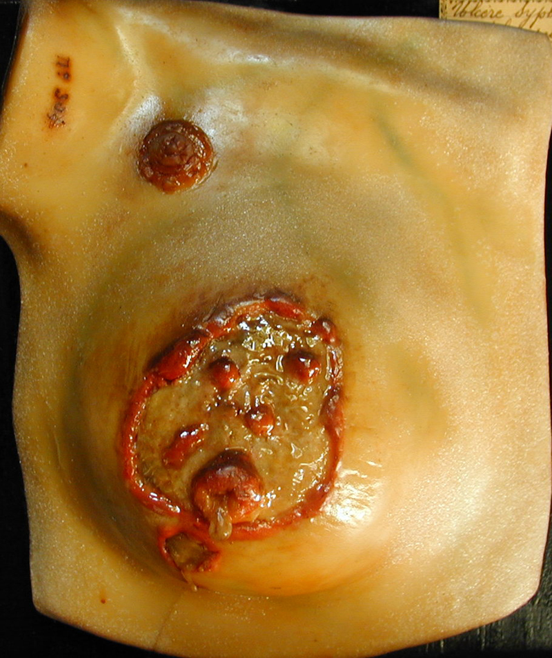 Cire anatomique d'une pathologie en dermatologie (Fontana)