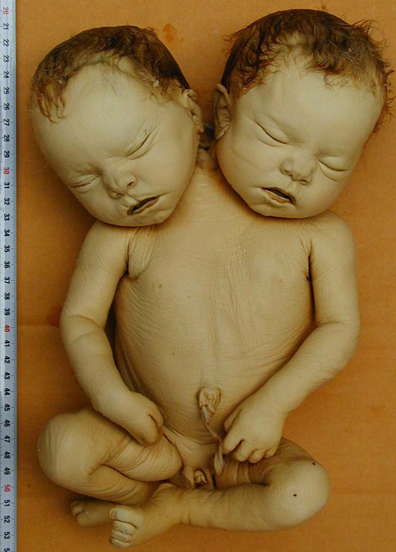 Fœtus à deux têtes